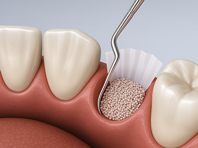Restoration Dental | Wisdom Teeth, Dentures and Dental Fillings
