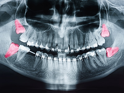 Restoration Dental | Digital Impressions, Dental Cleanings and CBCT