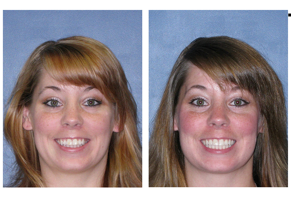 Restoration Dental