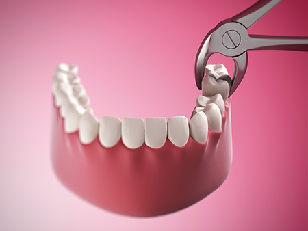 Restoration Dental | Dental Cleanings, Digital Impressions and Dental Fillings